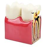Dental Caries Teeth Model Tooth Decay Model Bilateral Comparison Study 6 Times Pathology Cross-Section Demonstration Anatomy Education Model for Doctor-Patient Communication, Medical Teaching